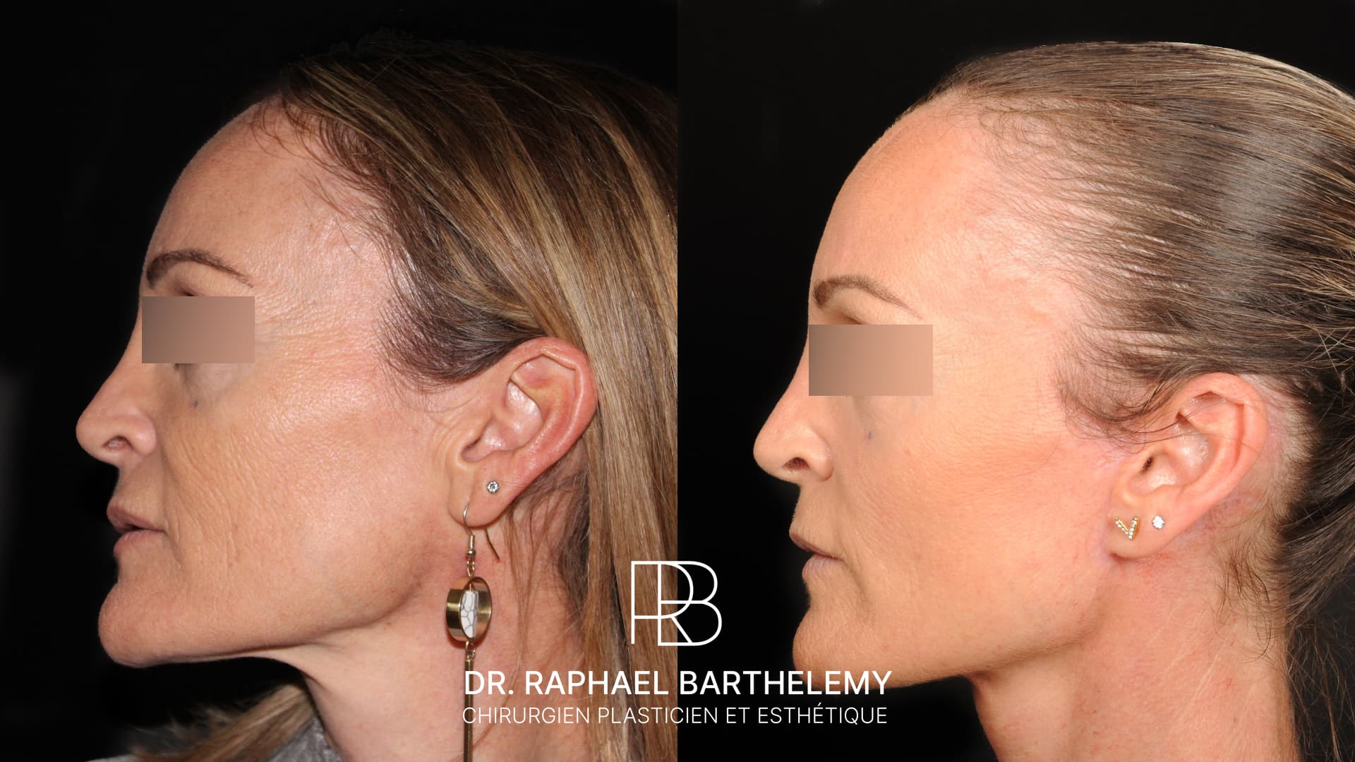 Résultat avant après d'un lifting du visage et du cou avec lipomodelage du visage réalisé par le Dr.Barthelemy à Marseille, vue de profil