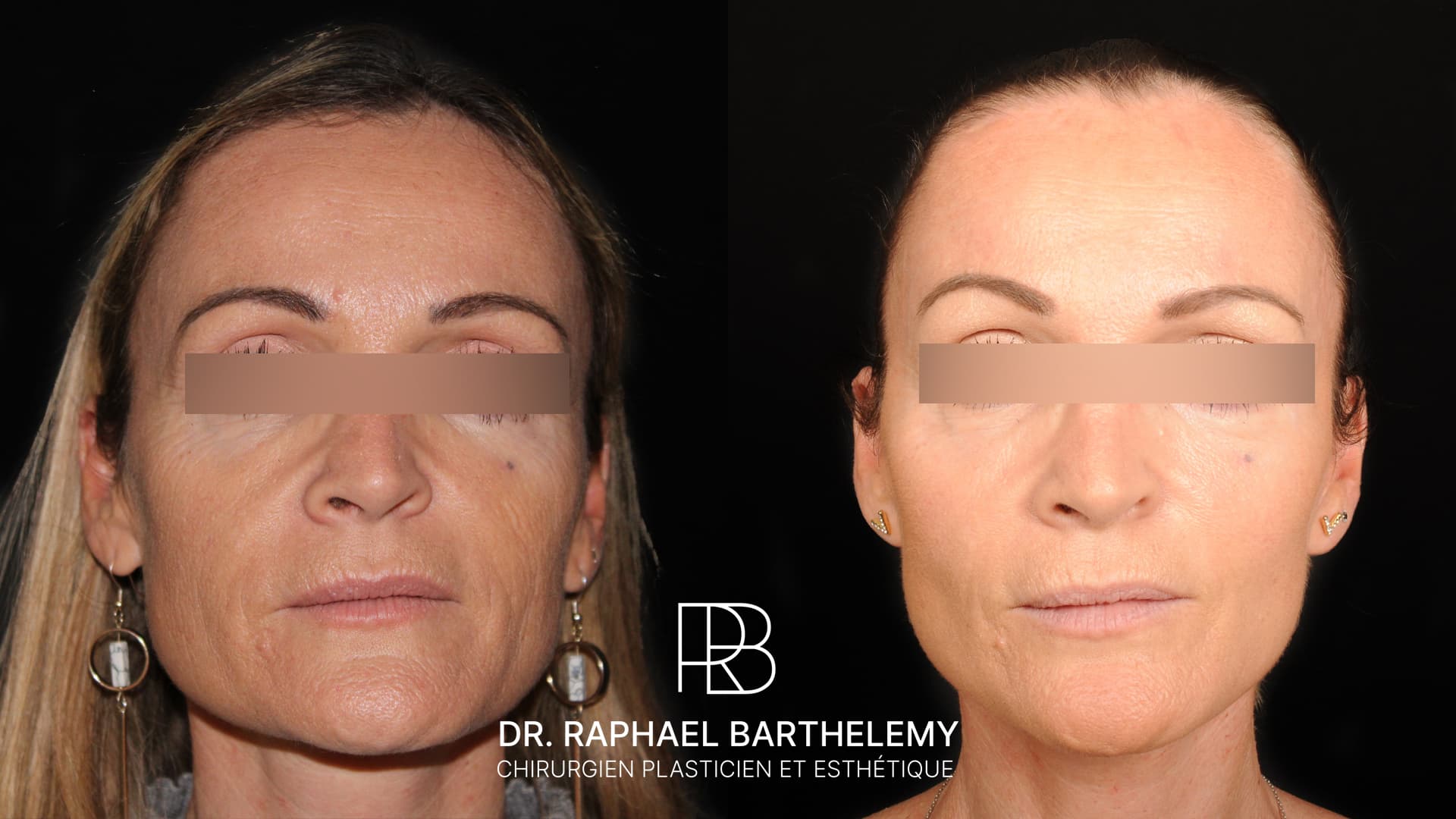 Résultat avant après d'un lifting du visage et du cou avec lipomodelage du visage réalisé par le Dr.Barthelemy à Marseille, vue de face