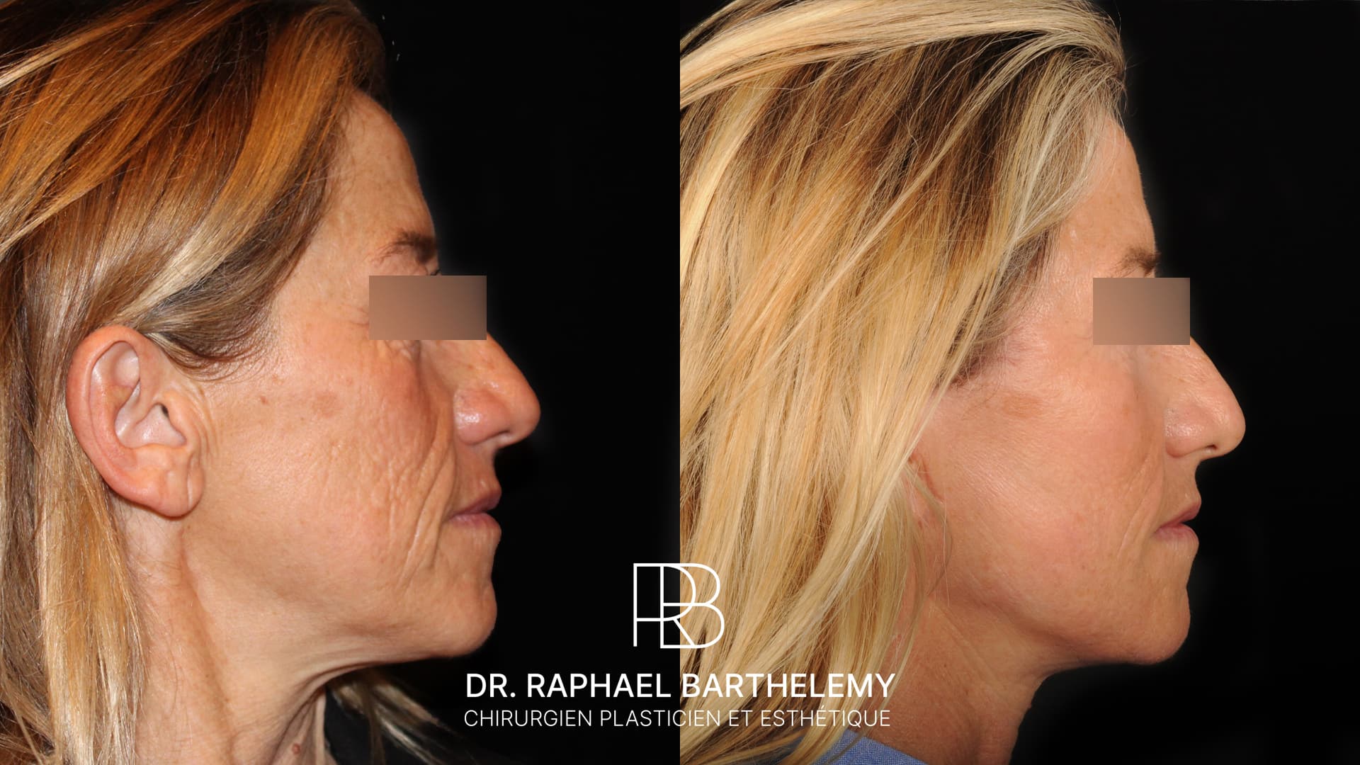 Résultat avant après d'un lifting du visage et du cou avec lipofilling du visage réalisé par le Dr.Barthelemy à Marseille, vue de profil