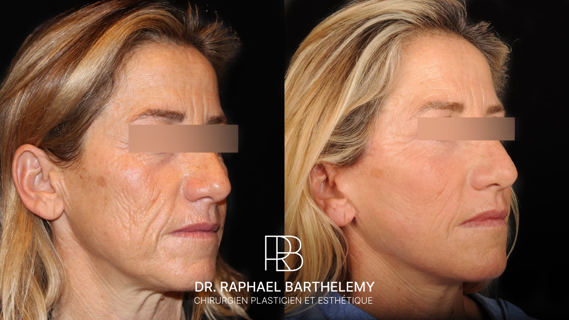 Résultat avant après d'un lifting du visage et du cou avec lipofilling du visage réalisé par le Dr.Barthelemy à Marseille, vue de trois-quarts