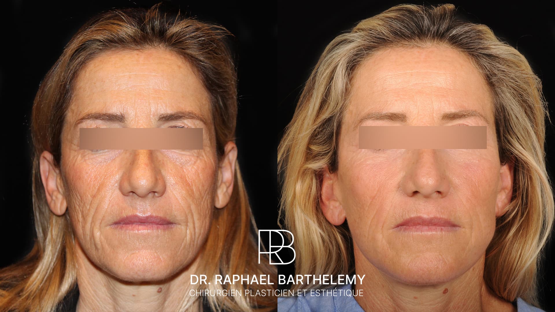 Résultat avant après d'un lifting du visage et du cou avec lipofilling du visage réalisé par le Dr.Barthelemy à Marseille, vue de face