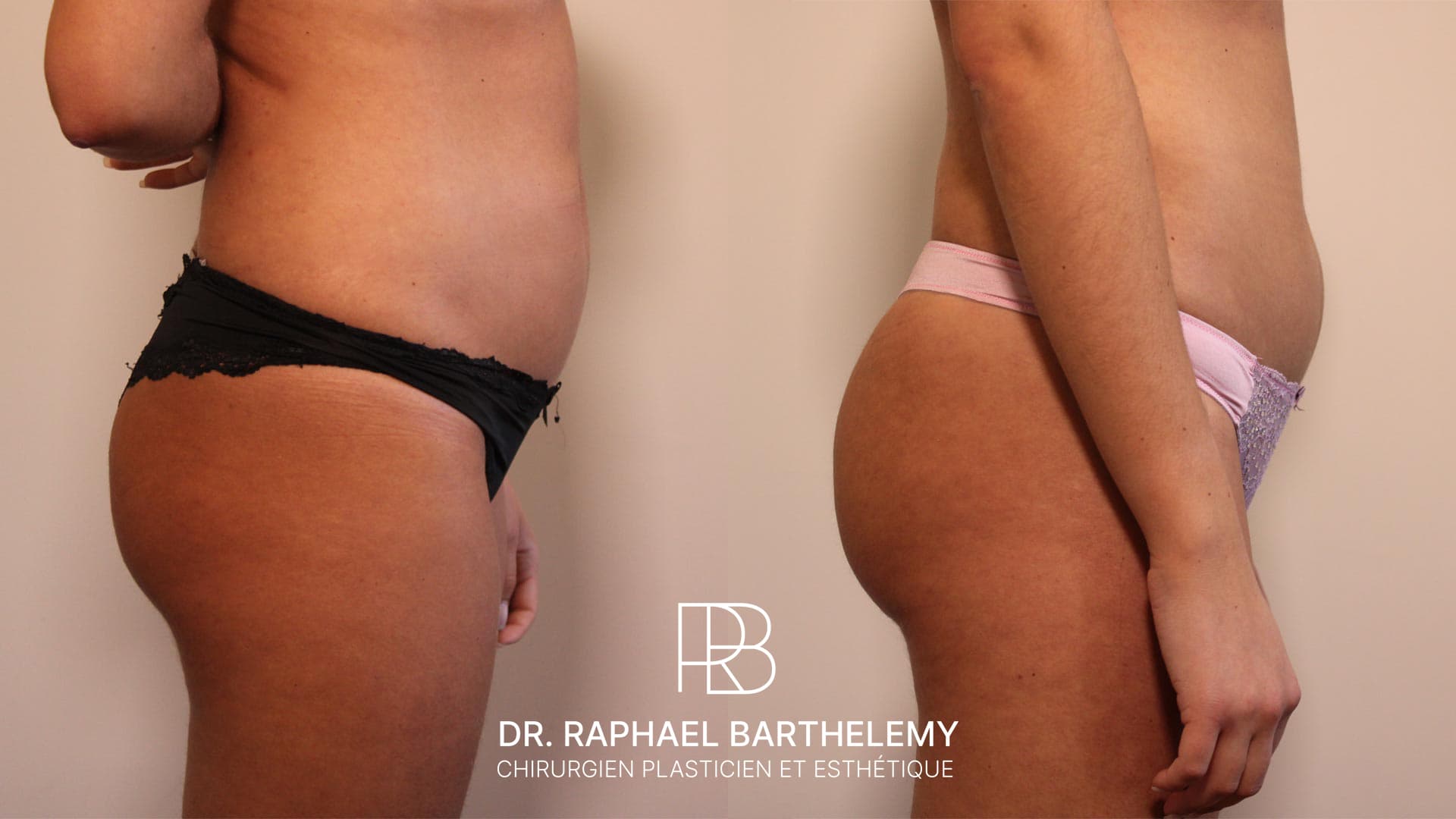 Résultat avant après d'une augmentation du volume des fesses par lipofilling réalisée par le Dr.Barthelemy à Marseille, vue de profil