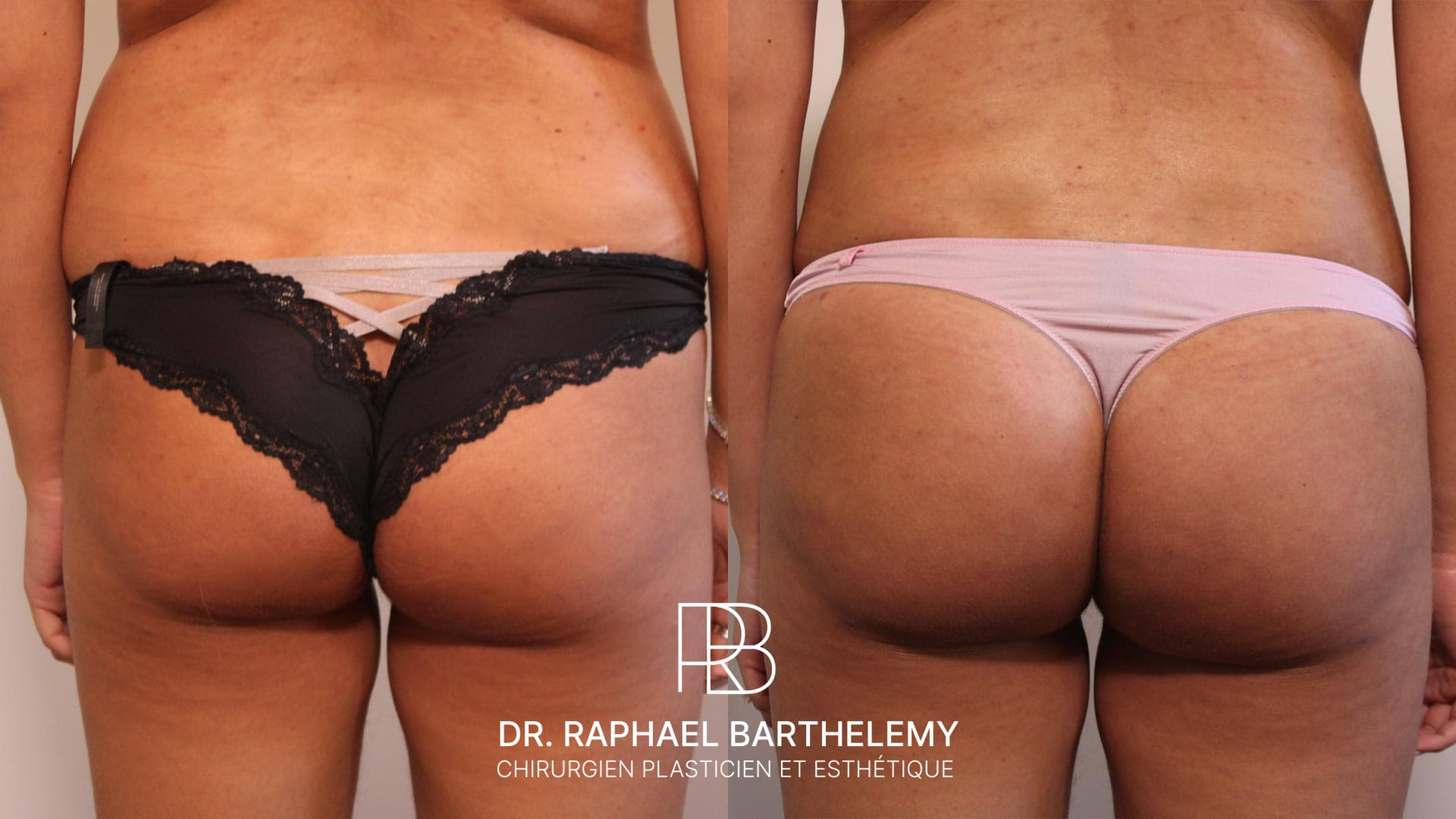 Résultat avant après d'une augmentation du volume des fesses par lipofilling réalisée par le Dr.Barthelemy à Marseille, vue de face