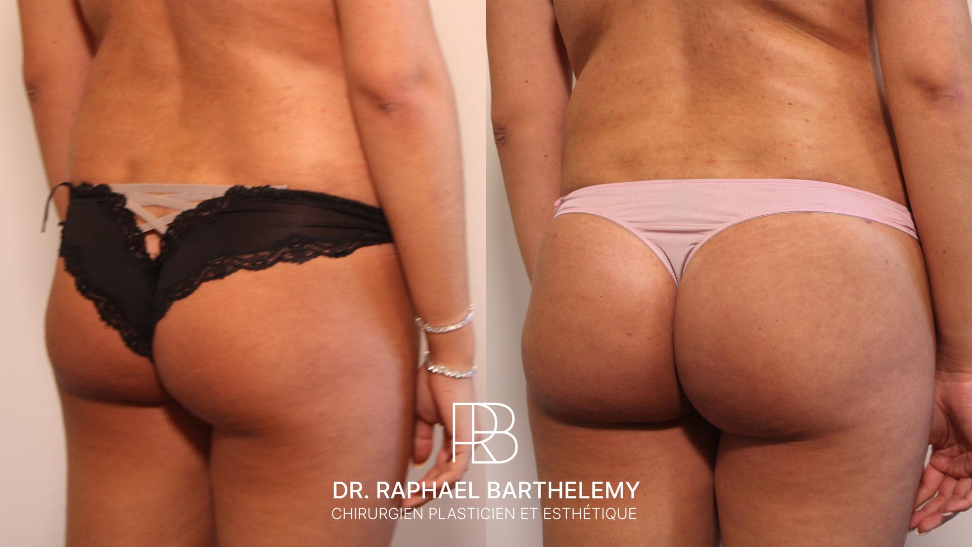 Résultat avant après d'une augmentation du volume des fesses par lipofilling réalisée par le Dr.Barthelemy à Marseille, vue de trois-quarts
