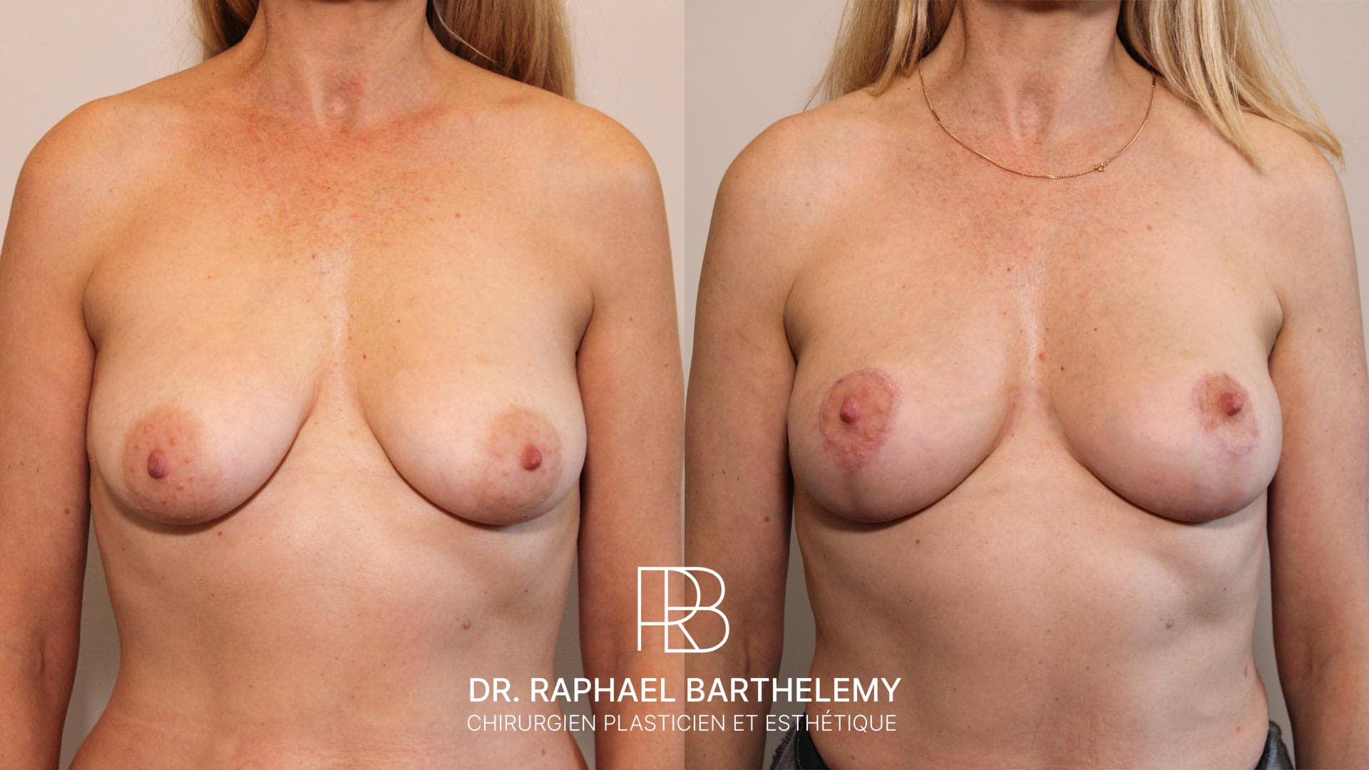 Résultat avant après d'un lifting des seins avec augmentation mammaire par lipofilling réalisé par le Dr.Barthelemy à Marseille, vue de face