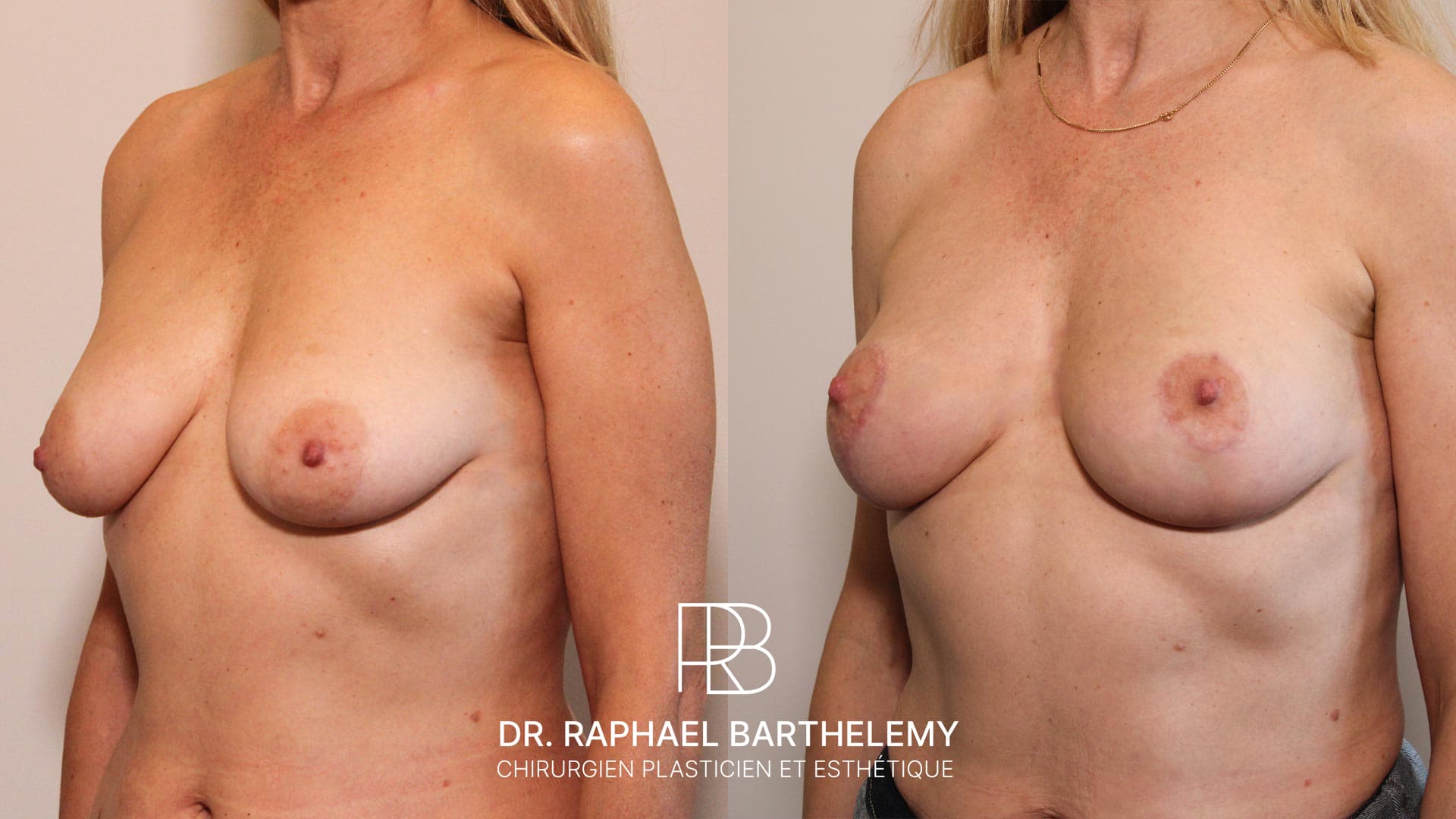 Résultat avant après d'un lifting des seins avec augmentation mammaire par lipofilling réalisé par le Dr.Barthelemy à Marseille, vue de trois-quarts