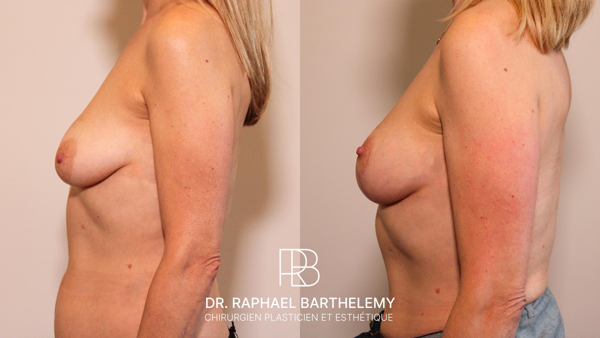 Résultat avant après d'un lifting des seins avec augmentation mammaire par lipofilling réalisé par le Dr.Barthelemy à Marseille, vue de profil