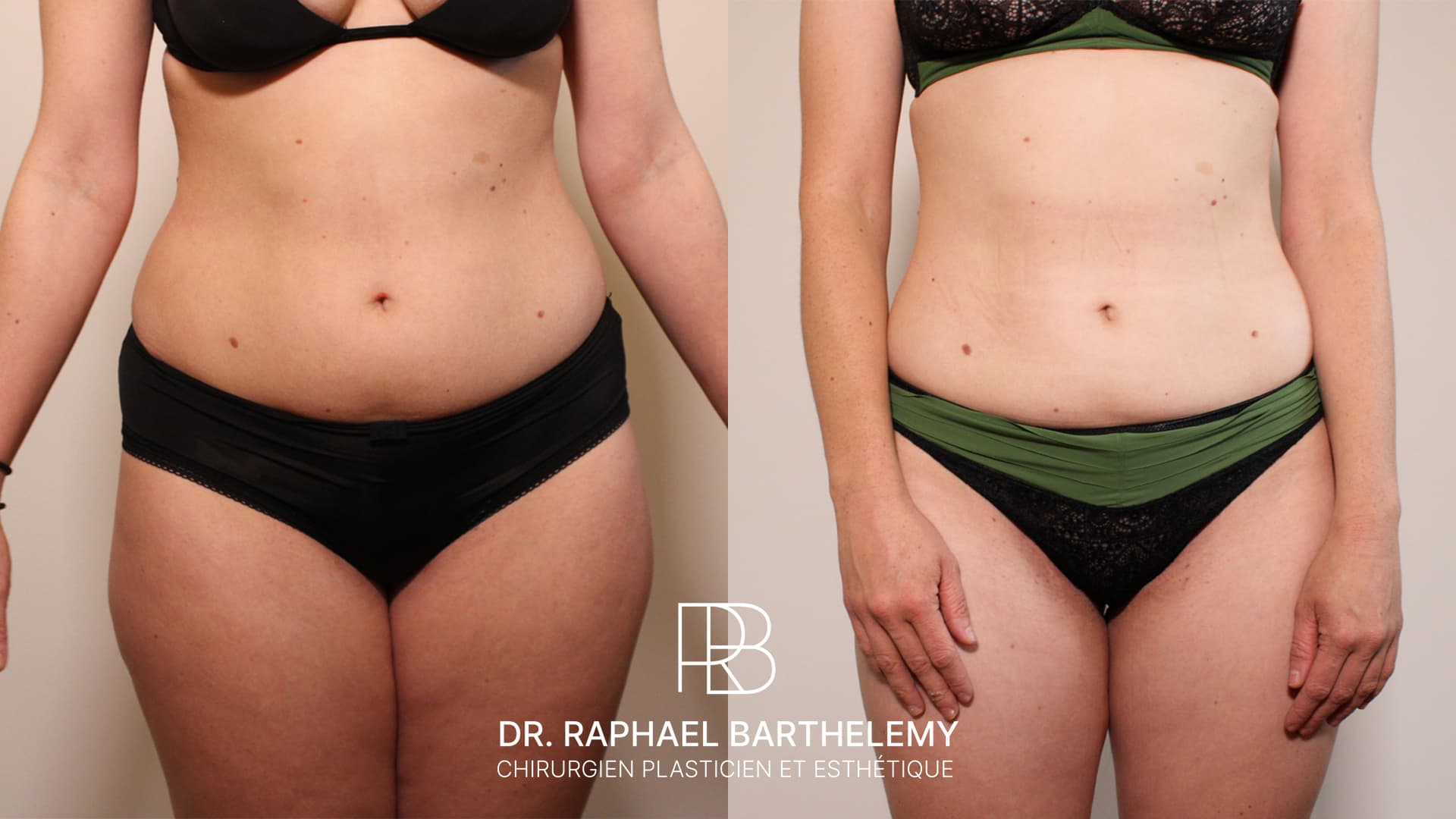 Résultat avant après d'une lipoaspiration de la silhouette réalisée par le Dr.Barthelemy à Marseille, vue de face