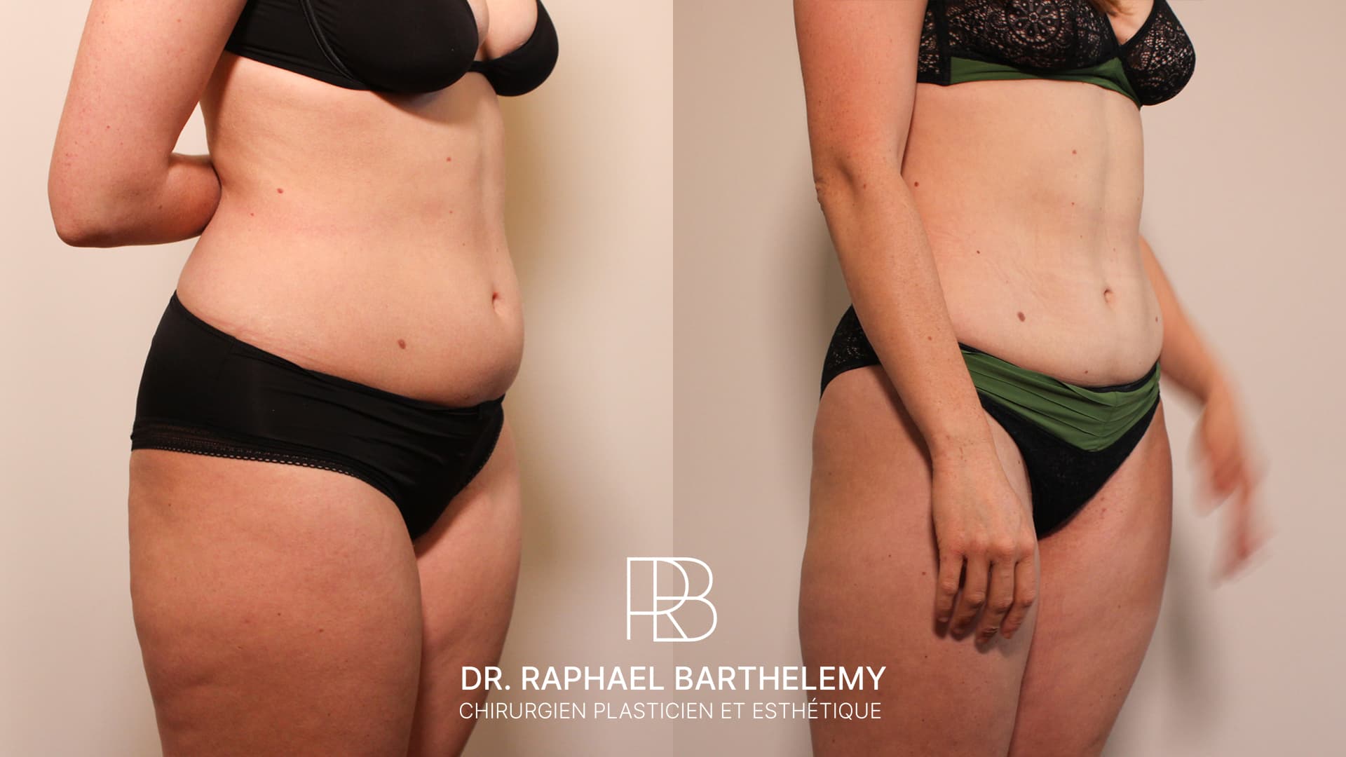 Résultat avant après d'une lipoaspiration de la silhouette réalisée par le Dr.Barthelemy à Marseille, vue de trois-quarts