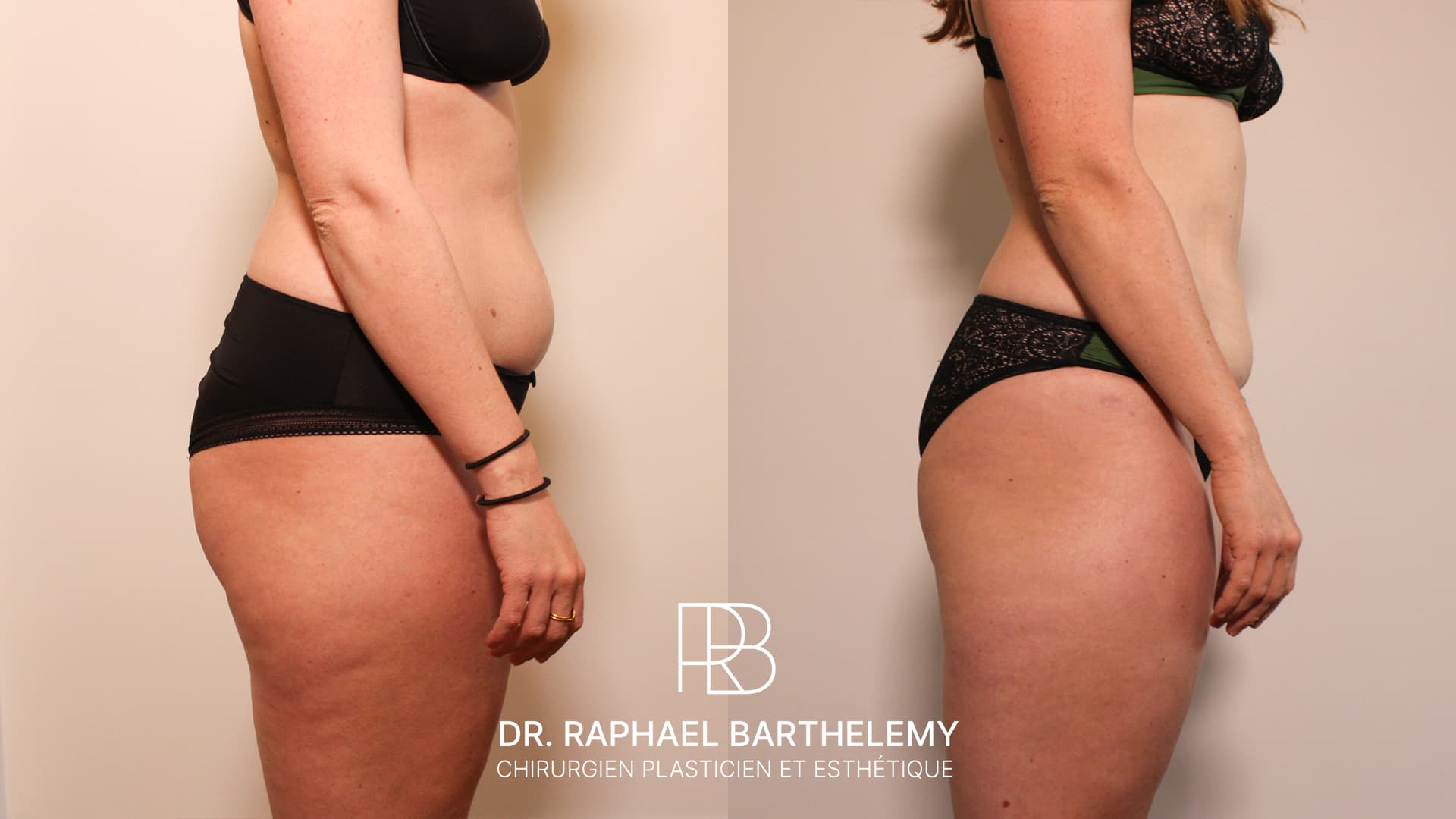 Résultat avant après d'une lipoaspiration de la silhouette réalisée par le Dr.Barthelemy à Marseille, vue de profil