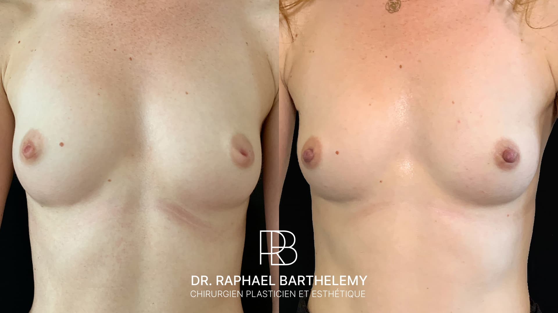 Résultat avant après d'une cure des mamelons ombiliqués réalisée par le Dr.Barthelemy à Marseille, vue de face