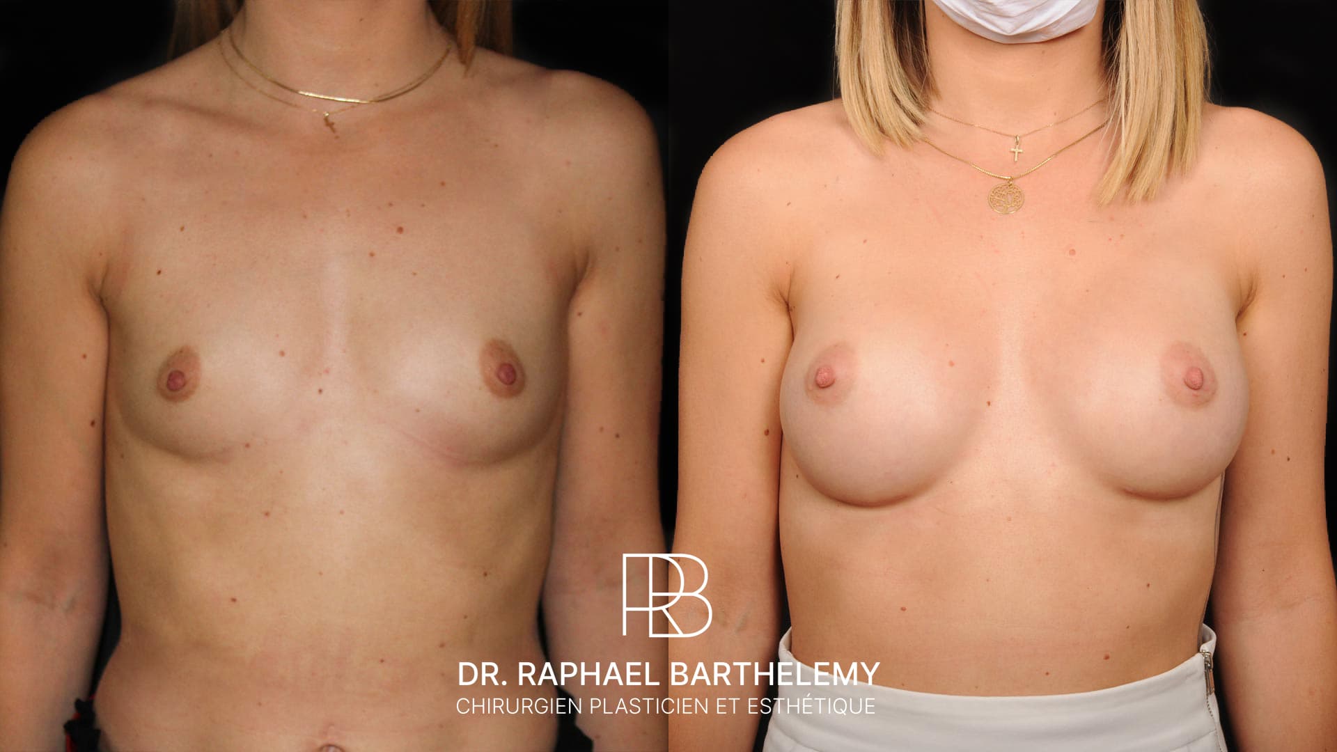 Résultat avant après d'une augmentation mammaire par prothèses en dual plan 290 cc réalisée par le Dr.Barthelemy à Marseille, vue de face