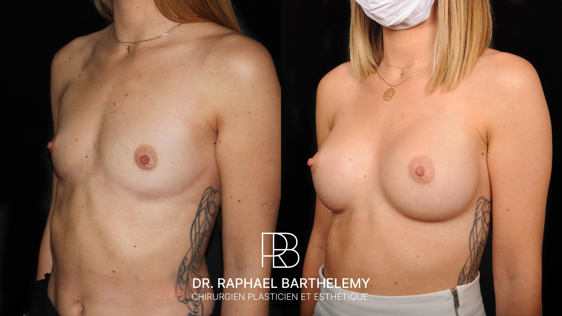 Résultat avant après d'une augmentation mammaire par prothèses en dual plan 290 cc réalisée par le Dr.Barthelemy à Marseille, vue de trois-quarts