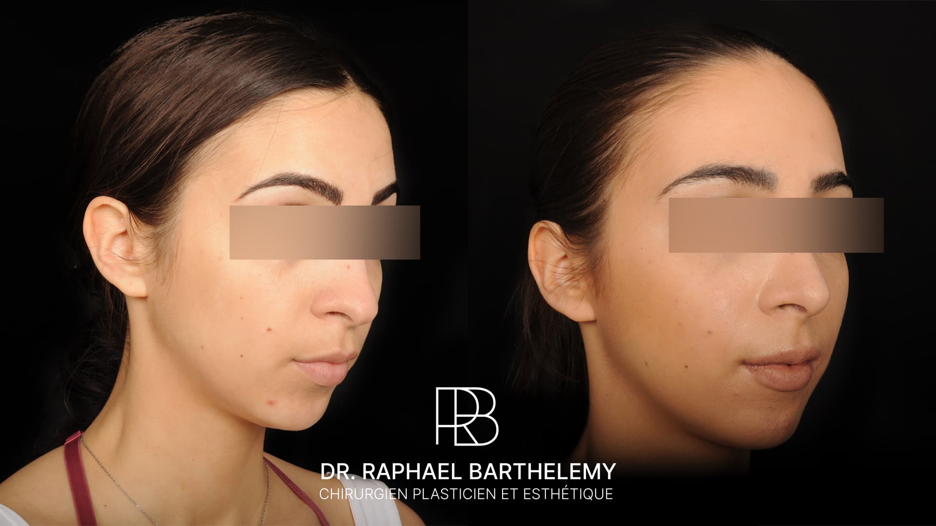 Résultat avant après d'une rhinoplastie par voie ouverte réalisée par le Dr.Barthelemy à Marseille, vue de trois-quarts