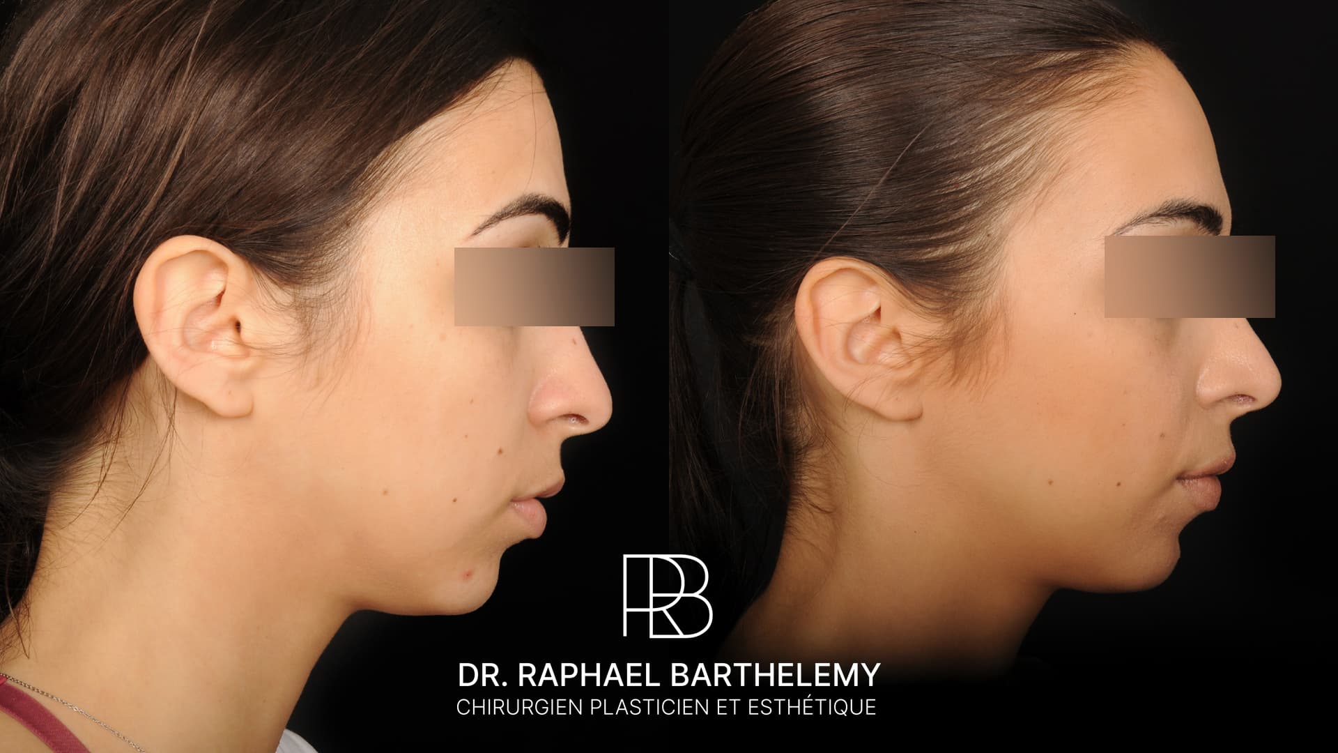 Résultat avant après d'une rhinoplastie par voie ouverte réalisée par le Dr.Barthelemy à Marseille, vue de profil