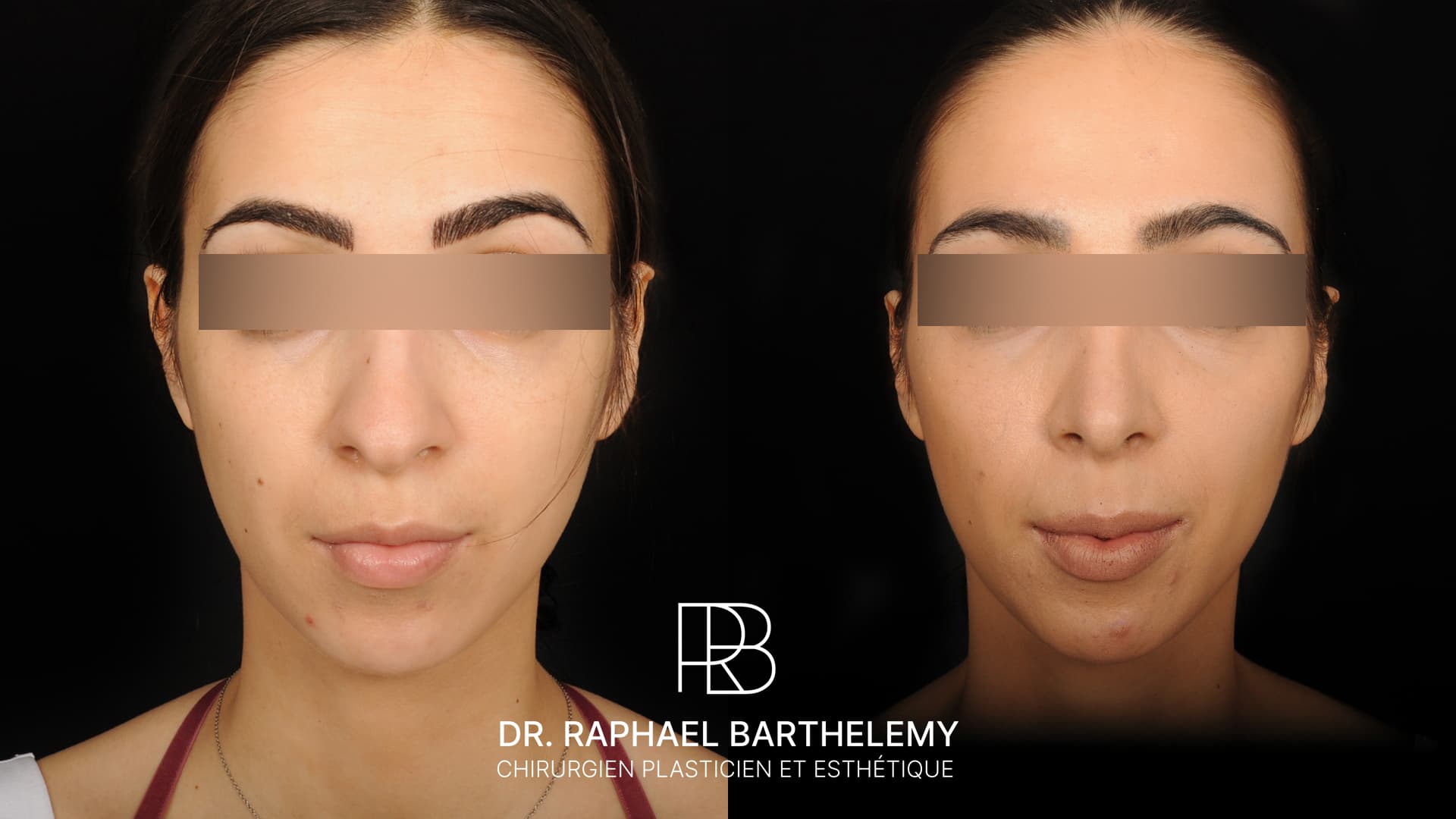 Résultat avant après d'une rhinoplastie par voie ouverte réalisée par le Dr.Barthelemy à Marseille, vue de face