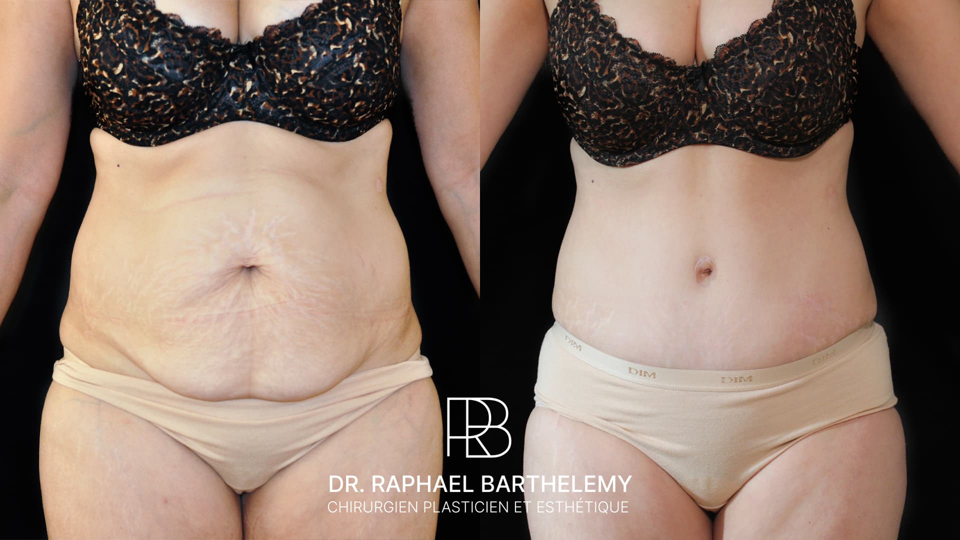 Abdominoplastie à Marseille, Intervention, soins, tarif